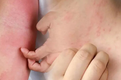 Uyuz Vakaları Artarak Devam Ediyor: Uzmanlar Uyarıyor, 15 Dakika Bile Yeterli Olabilir